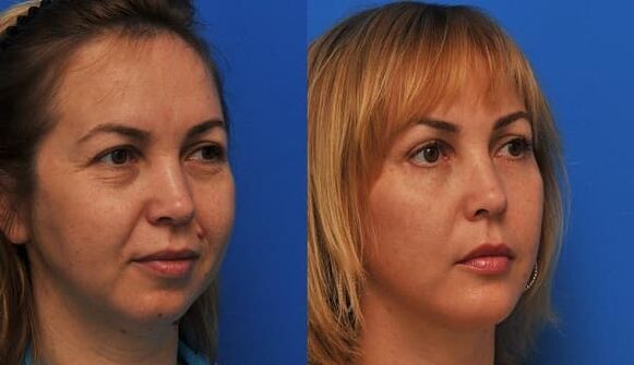 înainte și după întinerirea pielii cu strângere Foto 1