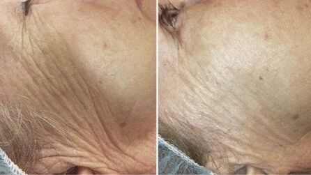 înainte și după întinerirea pielii cu laser